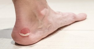 Are blisters symptoms of diabetes?